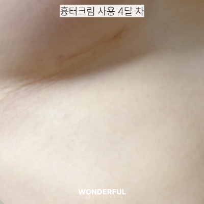 성형 수술 후 붓기와 흉터, 어떤 크림을 써야 할까? 후관리 연고 추천! 사진 4