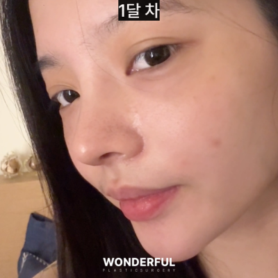 눈밑지방재배치 Q&A, 가장 많이 묻는 질문 4가지! 사진 9