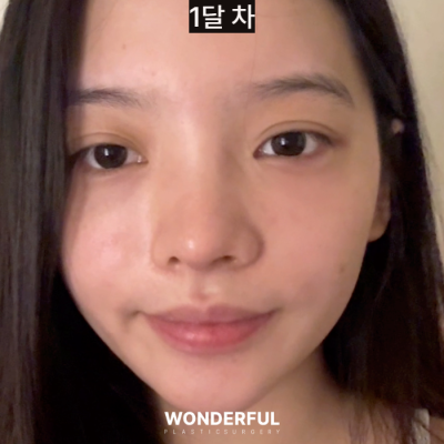 눈밑지방재배치 Q&A, 가장 많이 묻는 질문 4가지! 사진 7