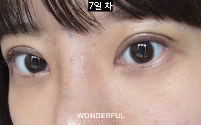 쌍수 재수술, 높은 라인 낮추기 한달 후기 사진 5