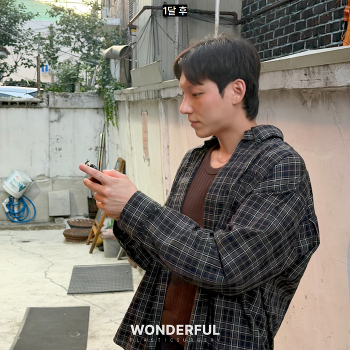 남자 매부리코 성형 변화, 일주일 한달차 붓기 사진 10