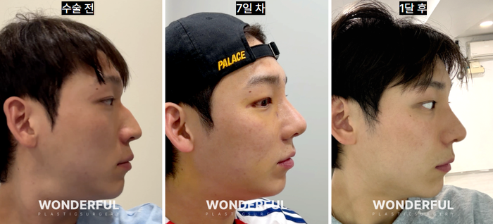 남자 매부리코 성형 변화, 일주일 한달차 붓기 사진 12