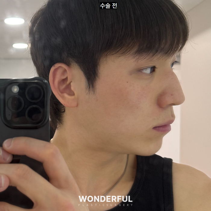 남자 매부리코 성형 변화, 일주일 한달차 붓기