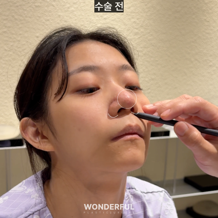 복코수술 후기|뭉툭한 코, 무보형물 성형 사진 10