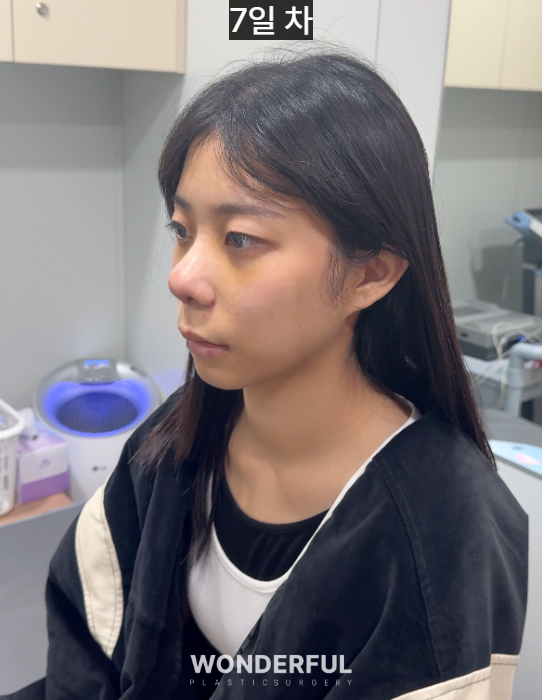 복코수술 후기|뭉툭한 코, 무보형물 성형 사진 6
