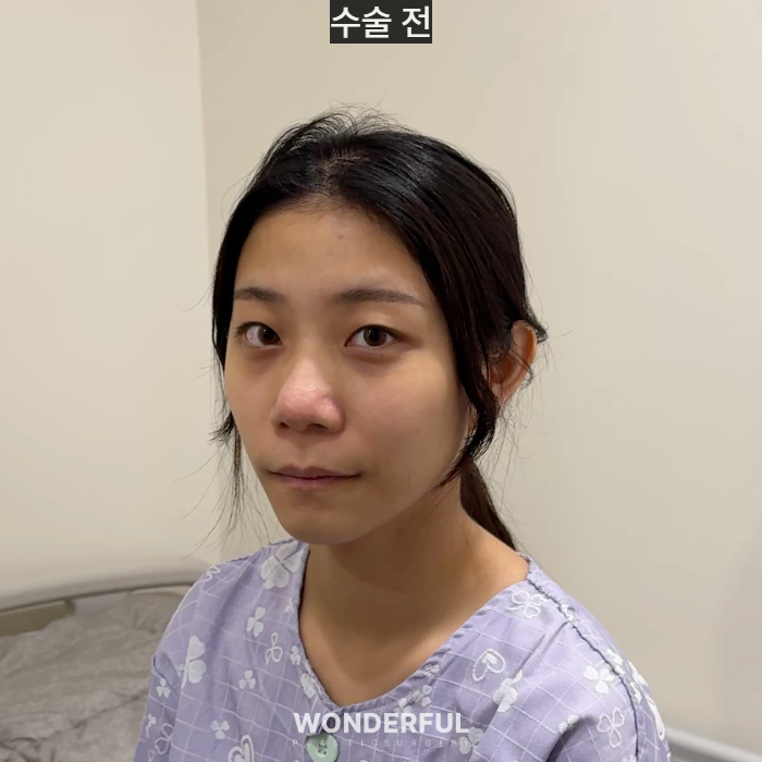복코수술 후기|뭉툭한 코, 무보형물 성형 사진 2