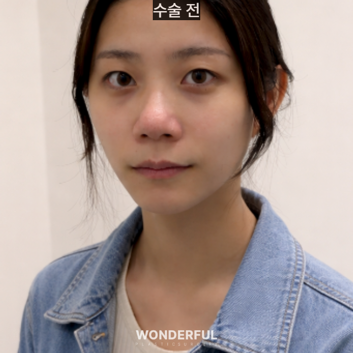 복코수술 후기｜뭉툭한 코, 무보형물 성형