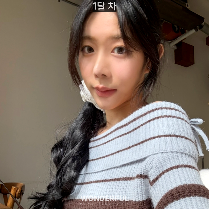 복코수술 후기|뭉툭한 코, 무보형물 성형 사진 8