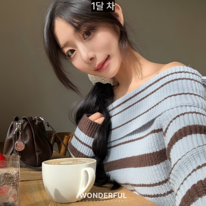 복코수술 후기|뭉툭한 코, 무보형물 성형 사진 7