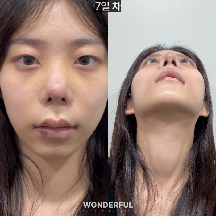복코수술 후기|뭉툭한 코, 무보형물 성형 사진 5