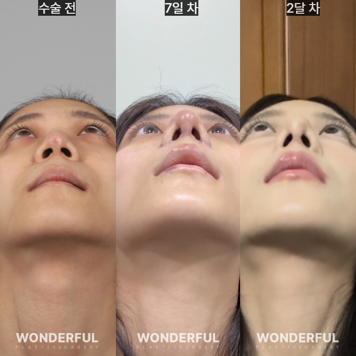 복코수술 후기|뭉툭한 코, 무보형물 성형 사진 9