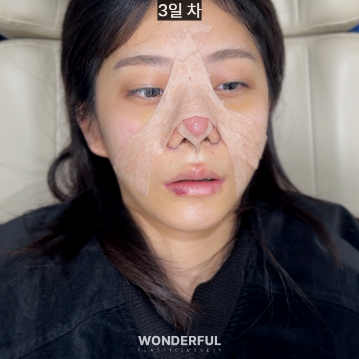 복코수술 후기|뭉툭한 코, 무보형물 성형 사진 3
