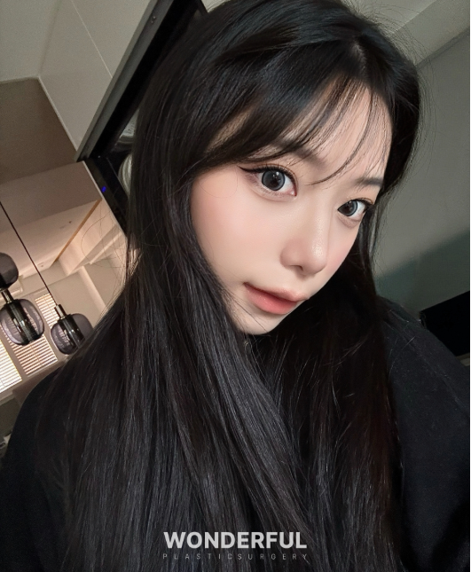 복코수술 후기|뭉툭한 코, 무보형물 성형 사진 11