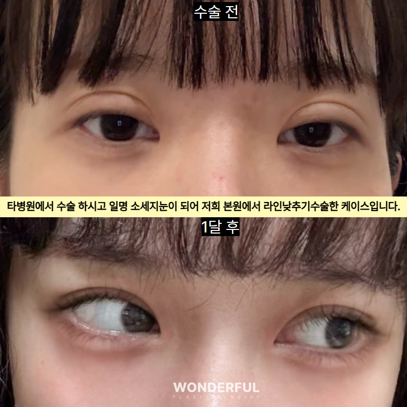 "쌍꺼풀 수술상담에서 원장님이 가장 많이 받는 질문 TOP5" 사진 4