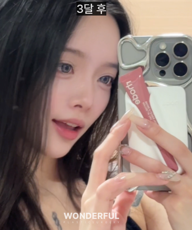 20대인데 벌써 눈밑지방재배치를 해도 될까요? 사진 7