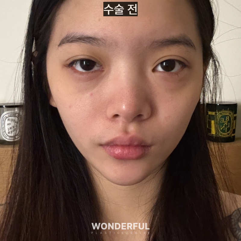 20대인데 벌써 눈밑지방재배치를 해도 될까요? 사진 2