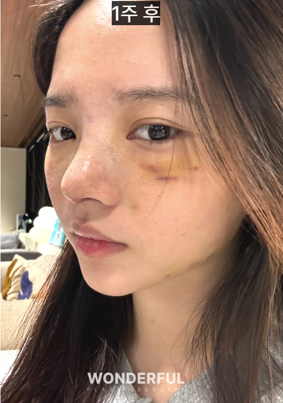 20대인데 벌써 눈밑지방재배치를 해도 될까요? 사진 5