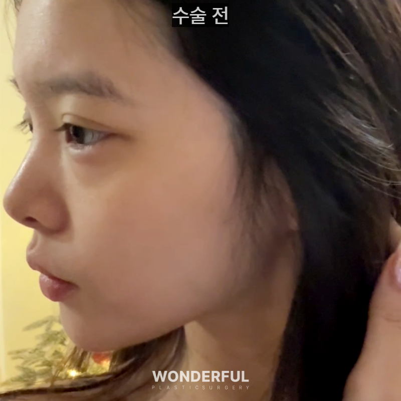 20대인데 벌써 눈밑지방재배치를 해도 될까요? 사진 8