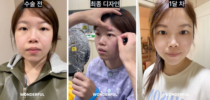 성형수술 전 최종 디자인, 왜 꼭 필요할까요?