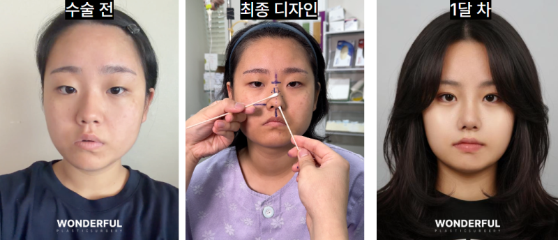 성형수술 전 최종 디자인, 왜 꼭 필요할까요? 사진 6