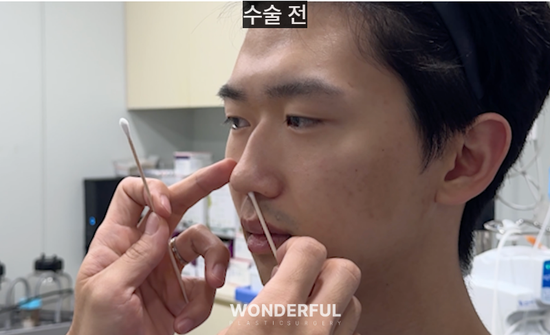 변우석 눈코처럼 성형했습니다. 남자 대변신, 회복 일주일부터 한달