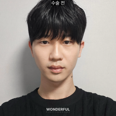 변우석 눈코처럼 성형했습니다. 남자 대변신, 회복 일주일부터 한달 사진 8