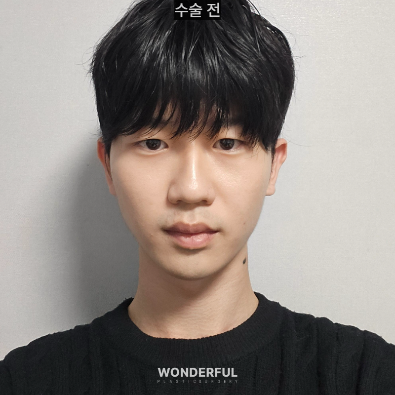 변우석 눈코처럼 성형했습니다. 남자 대변신, 회복 일주일부터 한달 사진 2