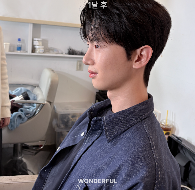 변우석 눈코처럼 성형했습니다. 남자 대변신, 회복 일주일부터 한달 사진 10