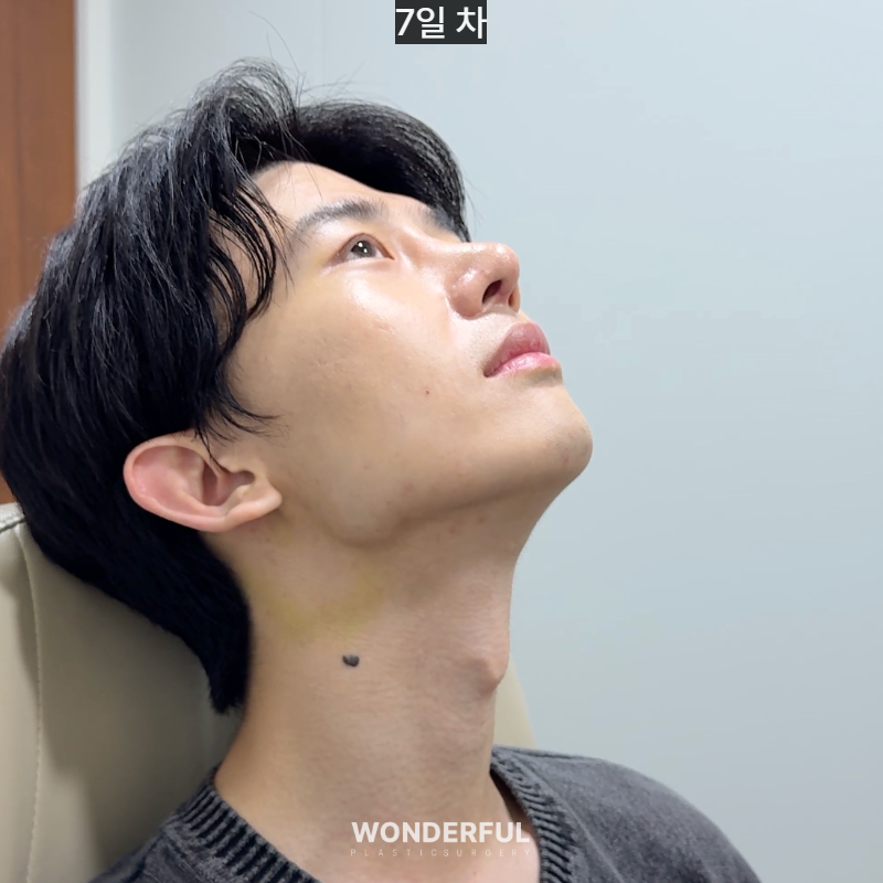 변우석 눈코처럼 성형했습니다. 남자 대변신, 회복 일주일부터 한달 사진 6