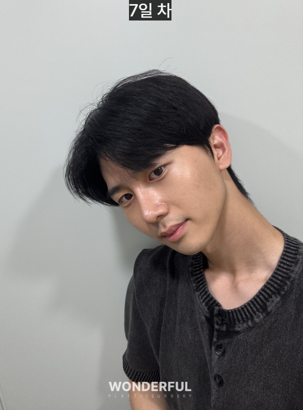 변우석 눈코처럼 성형했습니다. 남자 대변신, 회복 일주일부터 한달 사진 7