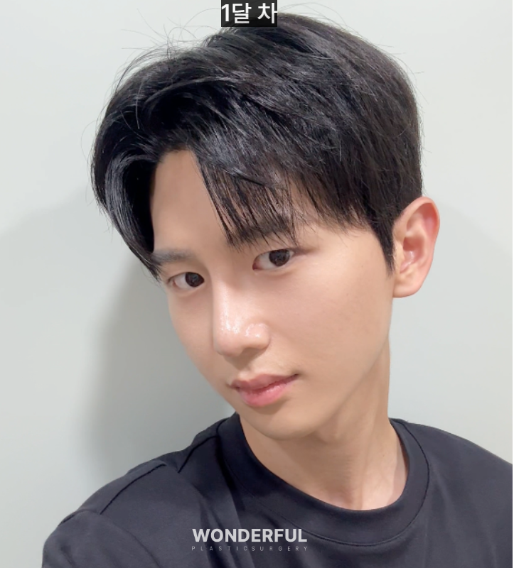 변우석 눈코처럼 성형했습니다. 남자 대변신, 회복 일주일부터 한달 사진 12