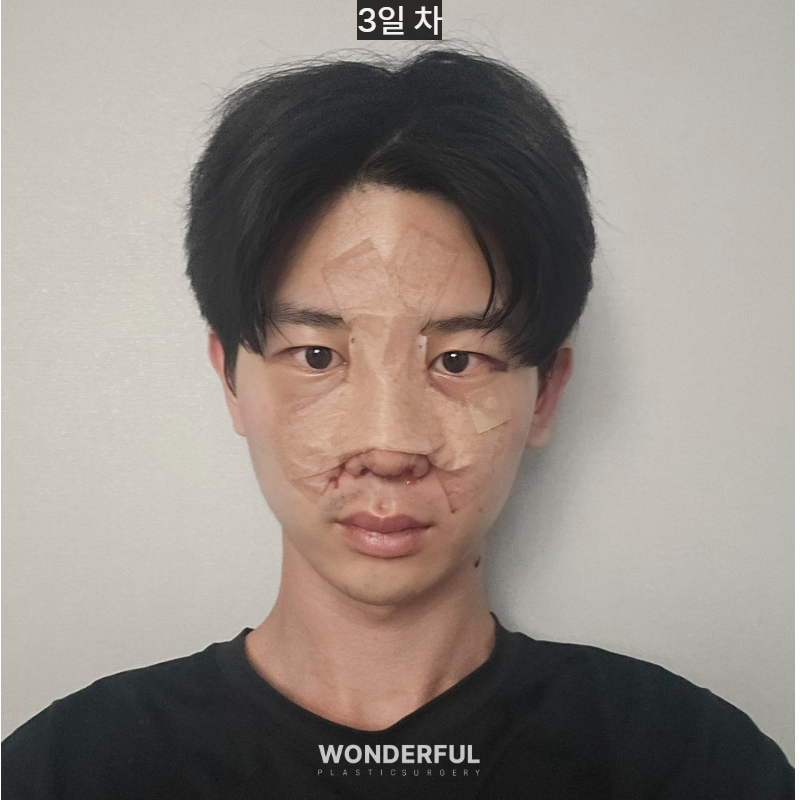 변우석 눈코처럼 성형했습니다. 남자 대변신, 회복 일주일부터 한달 사진 5