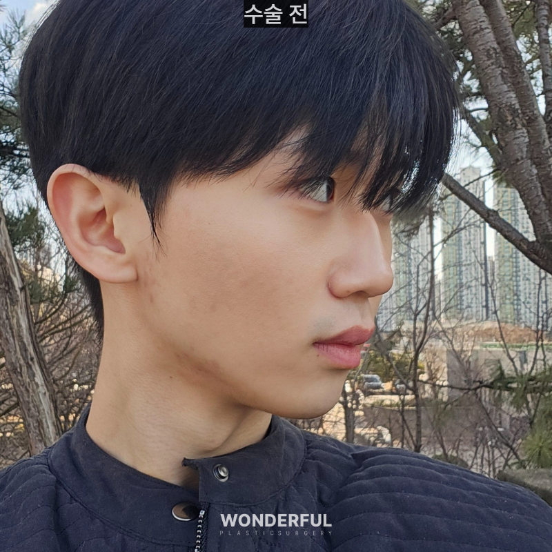 변우석 눈코처럼 성형했습니다. 남자 대변신, 회복 일주일부터 한달 사진 11