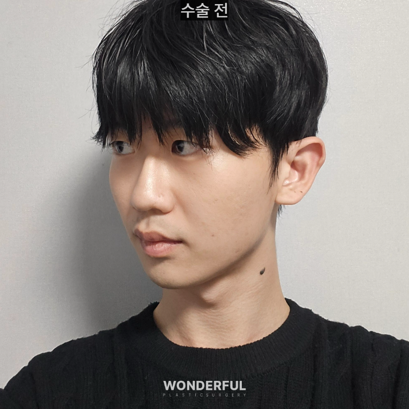 변우석 눈코처럼 성형했습니다. 남자 대변신, 회복 일주일부터 한달