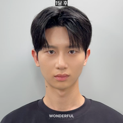 변우석 눈코처럼 성형했습니다. 남자 대변신, 회복 일주일부터 한달 사진 9