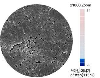 아이리움안과 스마일수술은 ‘로우에너지 스마일’입니다. 사진 3