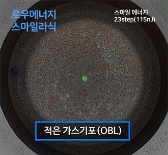 아이리움안과 스마일수술은 ‘로우에너지 스마일’입니다. 사진 5
