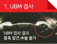 아이리움안과 만족도 높은 렌즈삽입술후기 사진 4