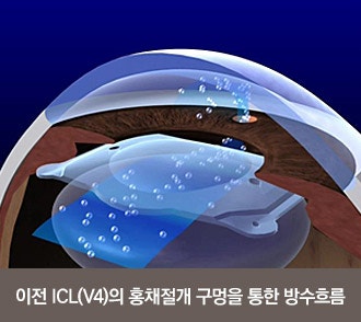 5년 연속 이보플러스ICL 베스트 센터로 선정, 아이리움안과를 선택하는 이유 사진 2