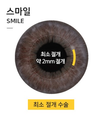 눈이 ㅇㅇ하면, 시력저하를 느낄 수 있다? 사진 5