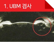 아이리움안과 렌즈삽입수술 후기 찾고 계신가요? 사진 4