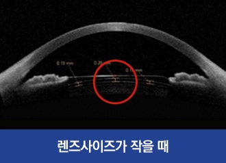 아쿠아렌즈삽입술 후 결과는? 수술 전 검사과정에서 찾을 수 있다! 사진 4