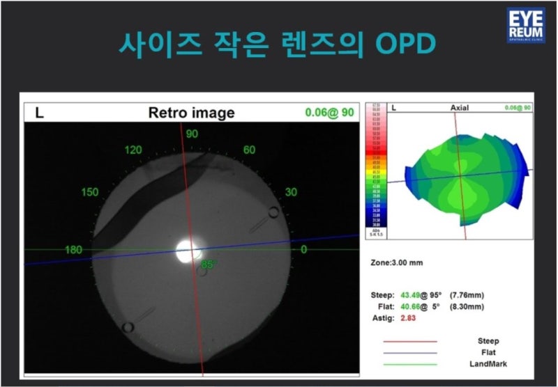 렌즈삽입술, 집도의가 중요한 이유 사진 4