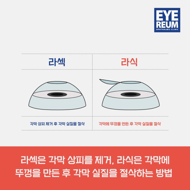 스마일라식 회복기간? 스마일라섹? 궁금해요! 사진 2