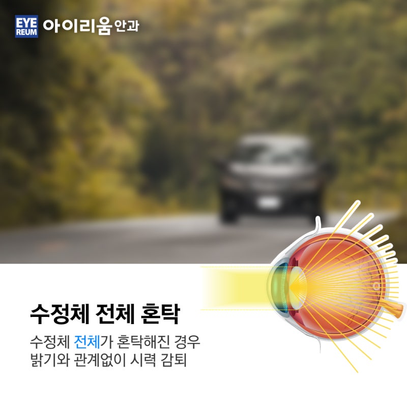백내장 종류 별 다른증상 [나는 무슨 백내장?] 사진 3