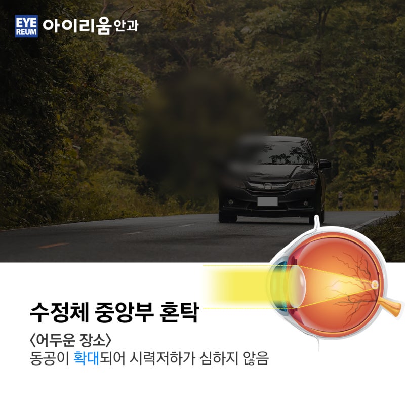 백내장 종류 별 다른증상 [나는 무슨 백내장?] 사진 5