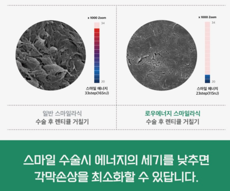 스마일라식 난시교정 벡터플래닝? 백타분석? 어려워요.. 사진 4