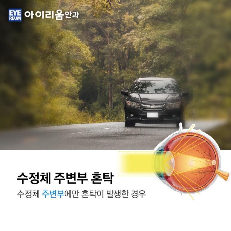 당뇨 환자의 백내장수술과 치료 사진 3