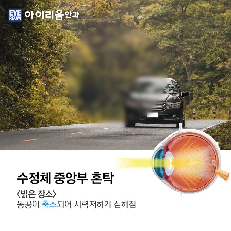 당뇨 환자의 백내장수술과 치료 사진 5