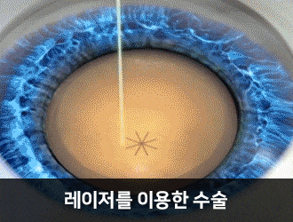 부모님 눈침침, 시력불편 원인부터 체크해보세요! 사진 10